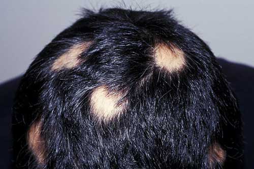 Alopecia Areata