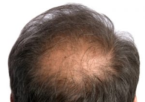 Androgenetic Alopecia