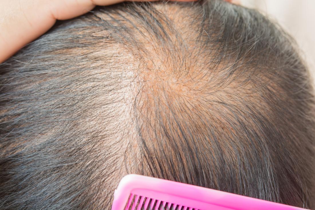 1. Causes of Thinning Hair in Women - wide 7